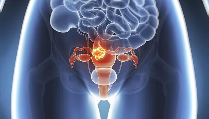 endometrialuterinecancer